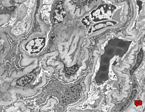 M,40y. | collapse of capillary loops M,40y. | collapse of capillary loops